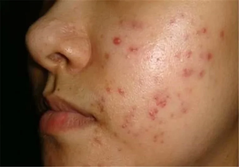 چگونه می‌توان با استفاده از طب سنتی از بروز جوش و آکنه جلوگیری کرد؟