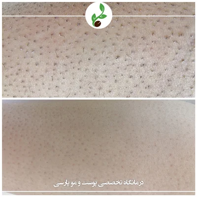 پوست