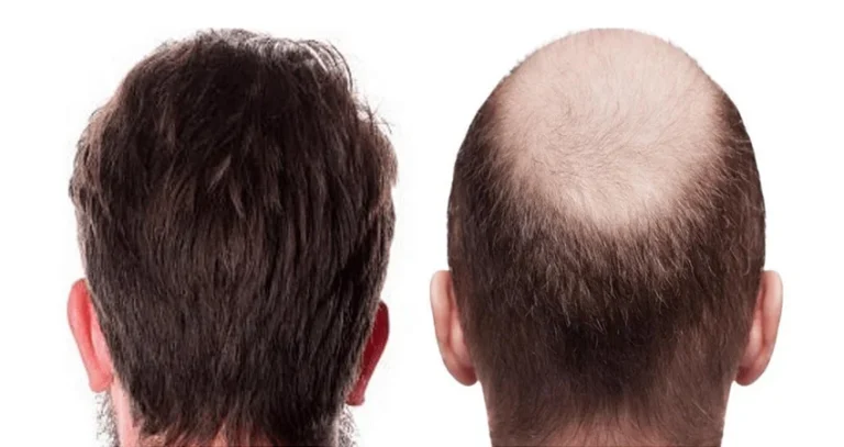 کاشت مو به روش Super FUE چیست و چقدر هزینه دارد ؟