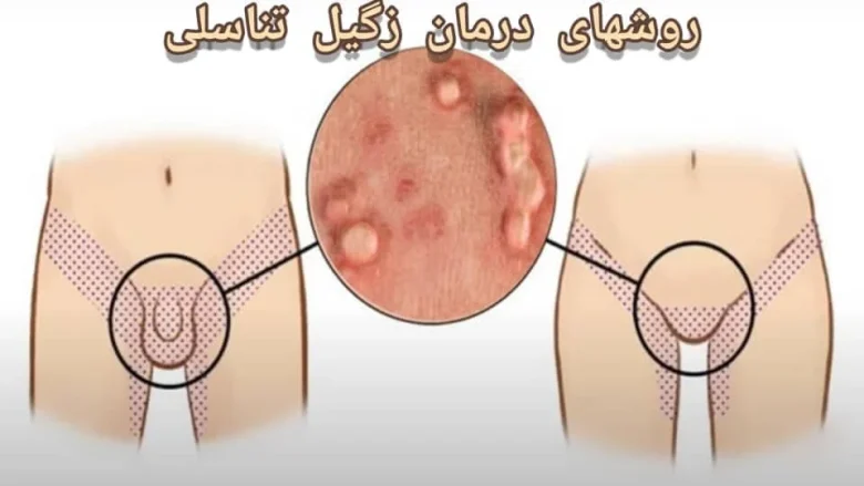 زگیل تناسلی