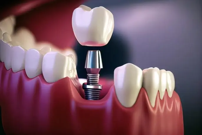 Is dental implant or dental laminate better