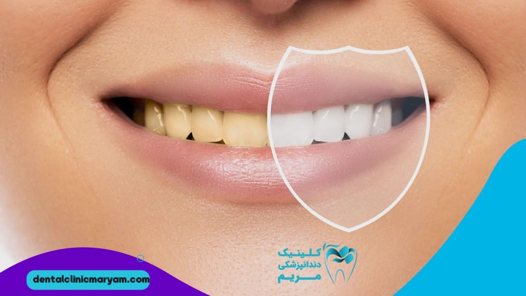 بهترین دکتر برای لمینت دندان در شیراز نی نی سایت |قیمت کامپوزیت دندان در شیراز |قیمت لمینت دندان در شیراز ۱۴۰۰