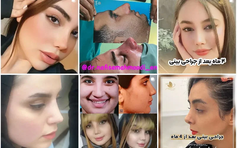 اصفهان بهترین جراح بینی در اصفهان