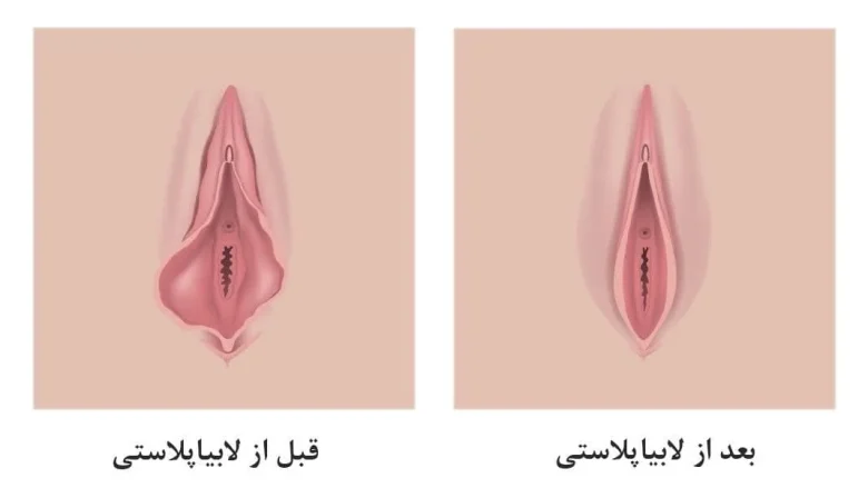 اپل