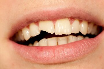 دندان چرا دندانها زود به زود پوسیده میشوند؟
