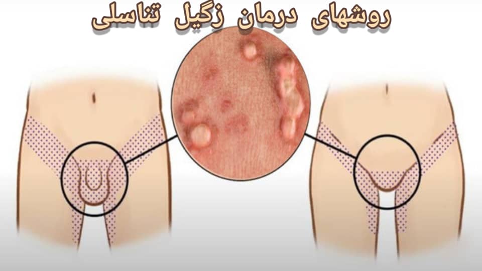 زگیل تناسلی