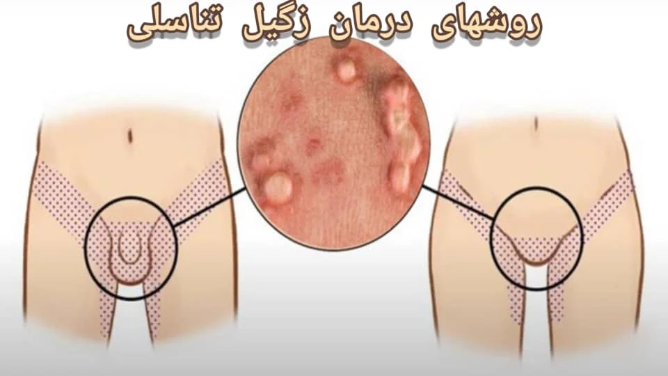 زگیل تناسلی زگیل تناسلی